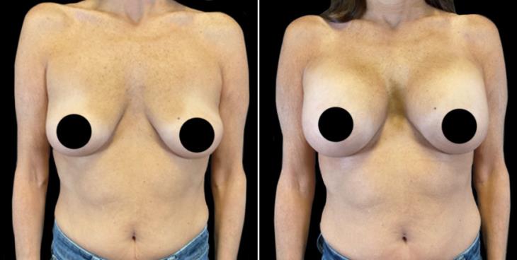 Before & After Breast Augmentation Marietta GA