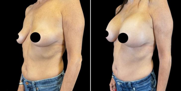 Marietta GA Before & After Breast Augmentation