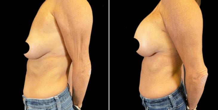 Before And After Breast Augmentation Marietta GA