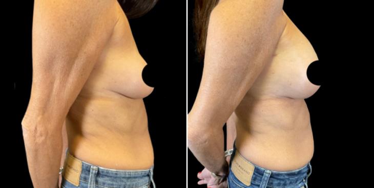 Marietta GA Before And After Breast Augmentation Side View