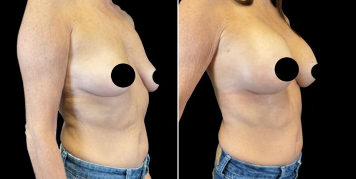 Marietta GA Before And After Breast Augmentation