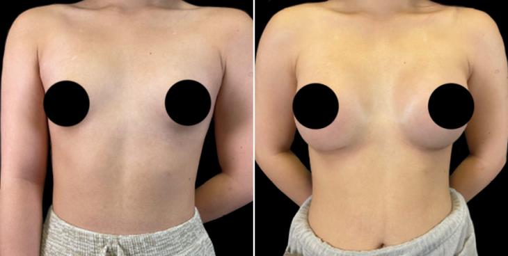Marietta GA Before And After Breast Augmentation Front View