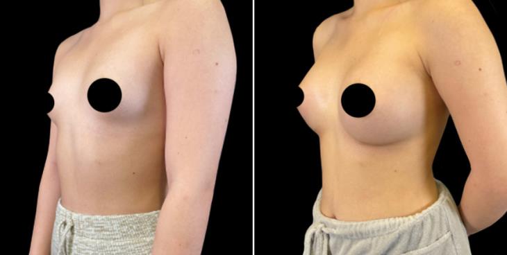 Marietta GA Before And After Breast Augmentation ¾ View