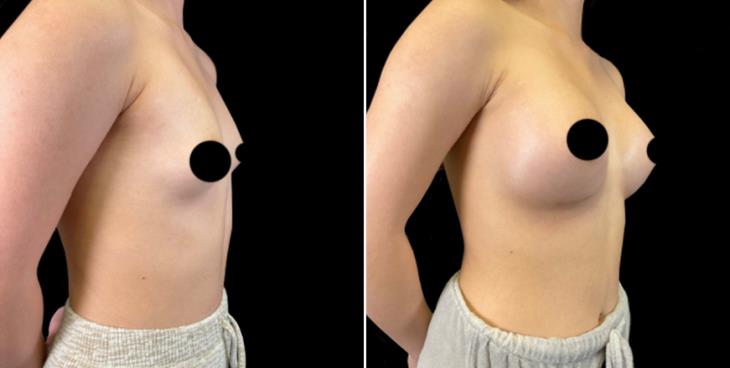 Breast Implants Cumming Before & After