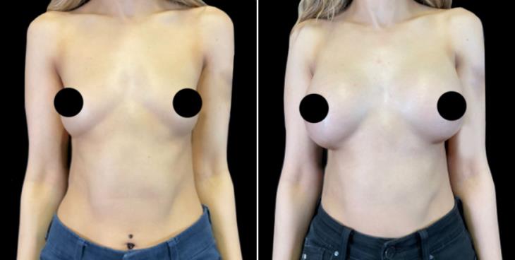 Before And After Breast Implants Cumming