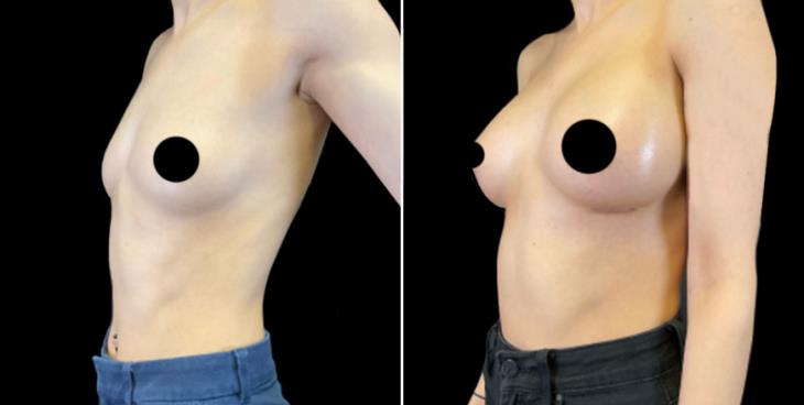 Before & After Breast Implants Cumming GA