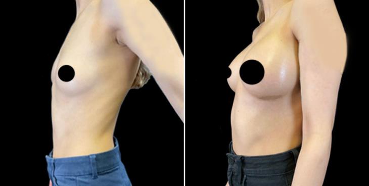 Cumming GA Breast Implants Before & After
