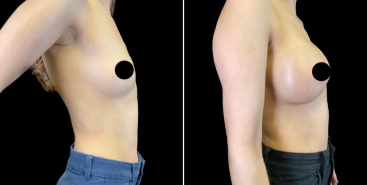 Cumming GA Breast Implants Before And After
