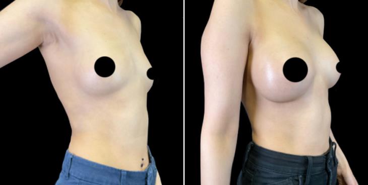 Before And After Breast Implants Cumming GA