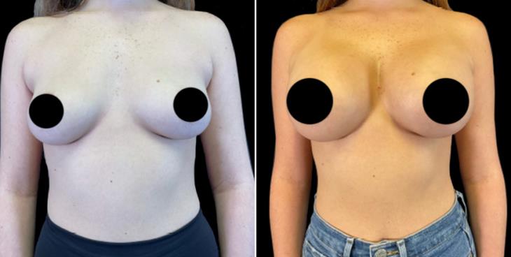 Cumming GA Breast Implants Before And After Front View