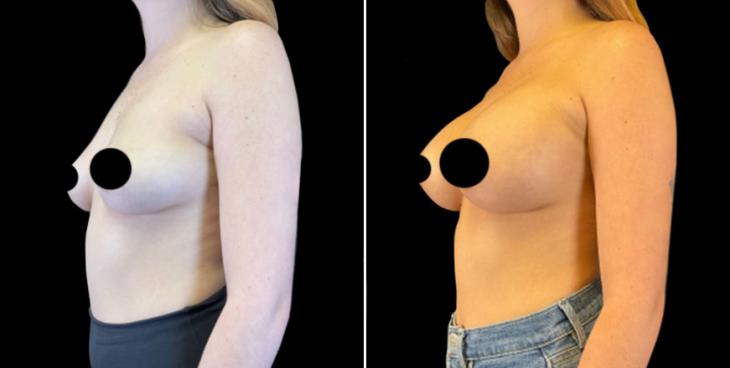 Cumming GA Breast Implants Before And After Side View