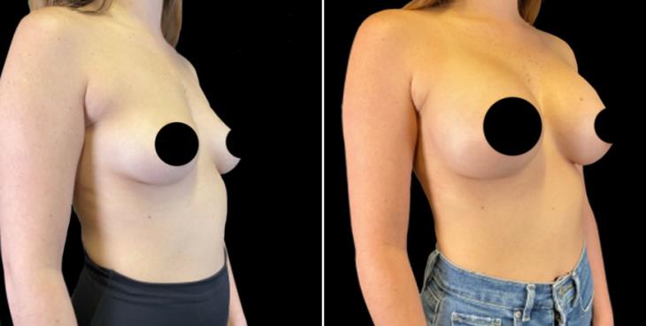 Cumming GA Breast Implants Before And After ¾ View