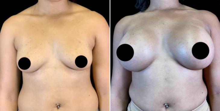 Breast Implants Cumming Georgia Before & After