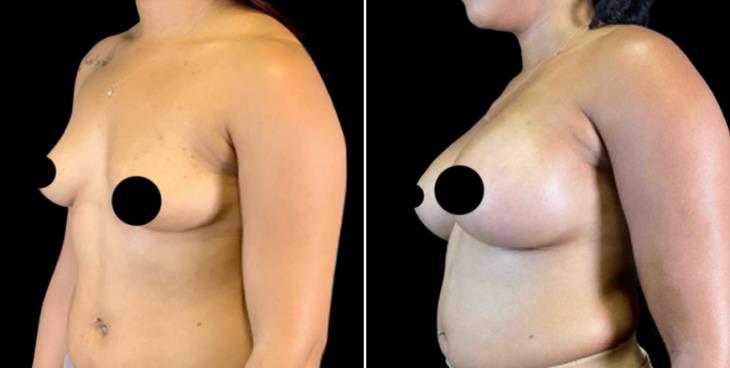 Cumming Georgia Breast Implants Before & After
