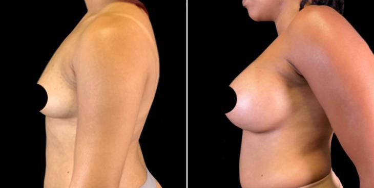 Breast Implants Cumming Georgia Before & After Side View