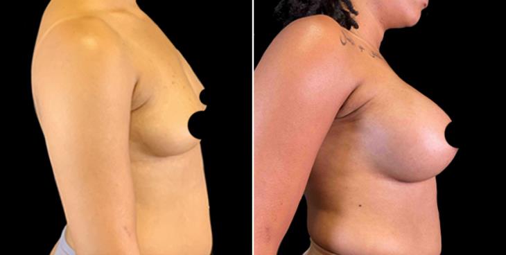 Cumming Georgia Breast Implants Before & After ¾ View