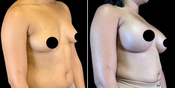 Breast Implants Cumming Georgia Before & After ¾ View