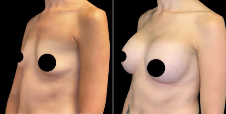 Cumming Georgia Breast Implants Before And After ¾ View