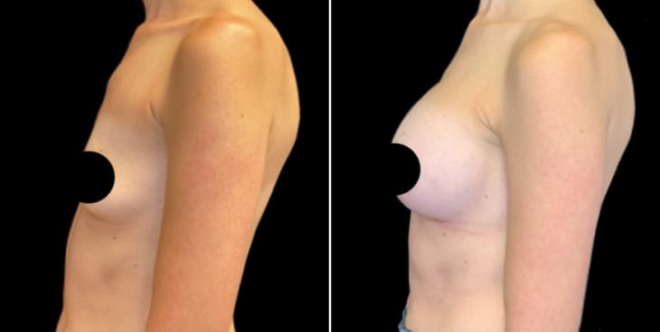 Cumming Georgia Breast Implants Side View