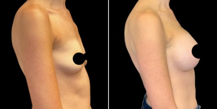 Breast Implants Side View Cumming Georgia