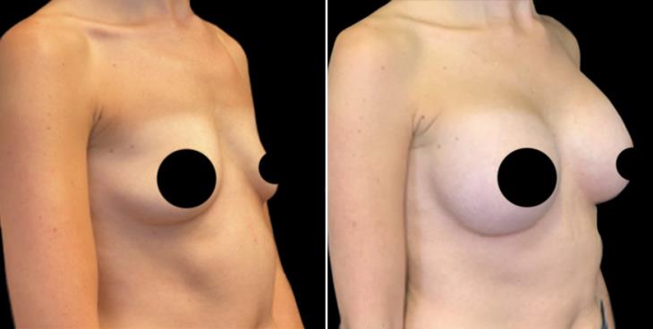 Breast Implants ¾ View Cumming Georgia
