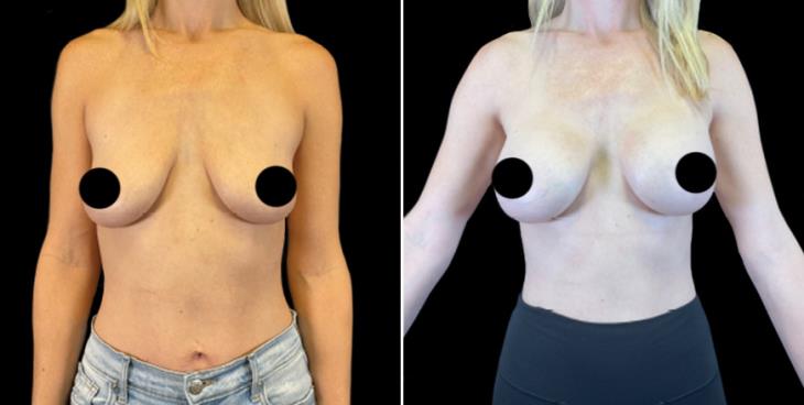 Breast Augmentation Results Marietta Front View