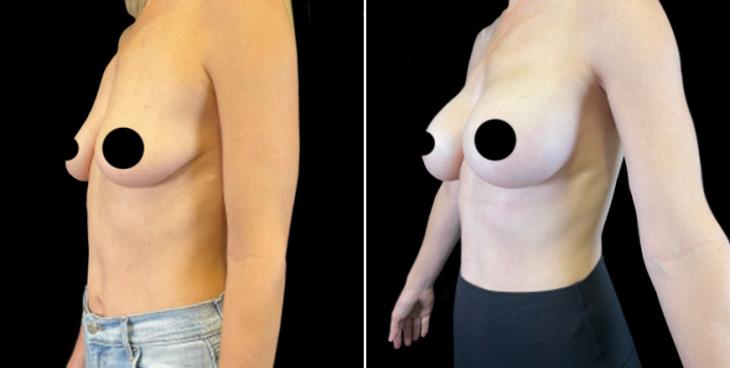 ¾ View Breast Augmentation Results Marietta