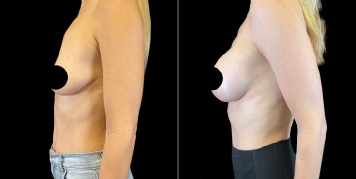 Breast Augmentation Results Marietta Side View