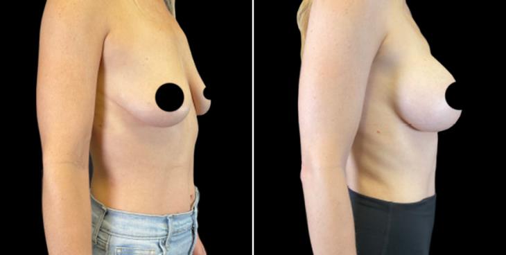 Breast Augmentation With Implants Results Georgia