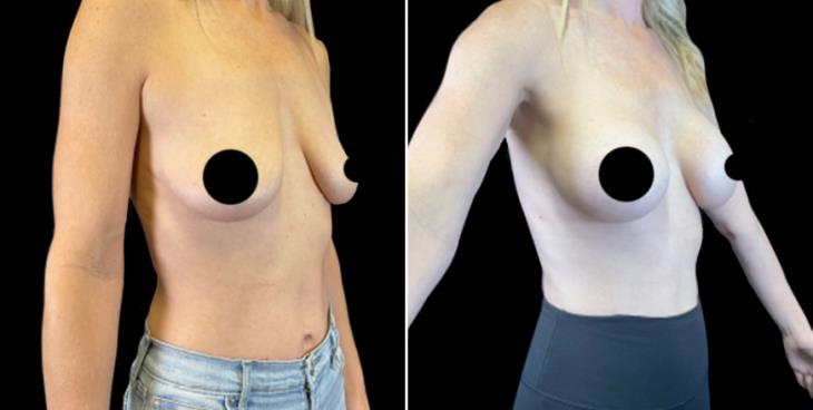 Breast Augmentation With Implants Results