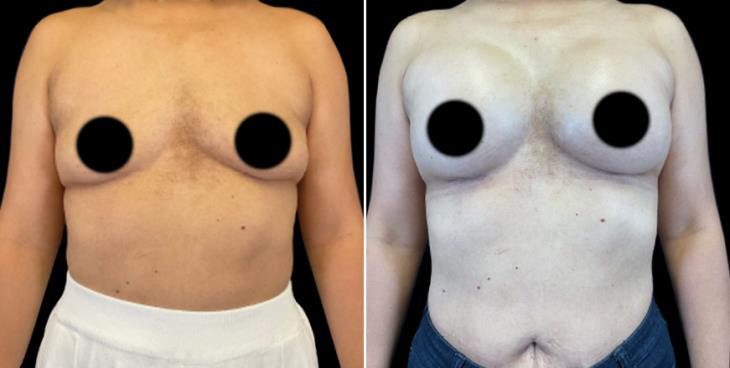Breast Augmentation With Implants Results GA