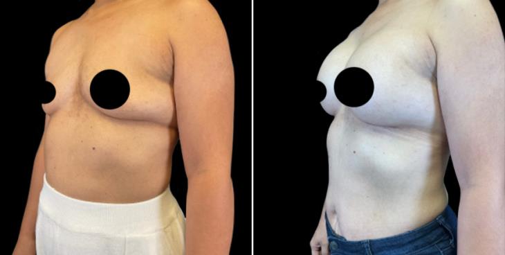 Breast Augmentation With Implants Results Atlanta
