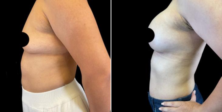 Breast Augmentation With Implants Results Atlanta GA