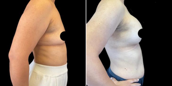 Breast Augmentation With Implants Results Marietta GA