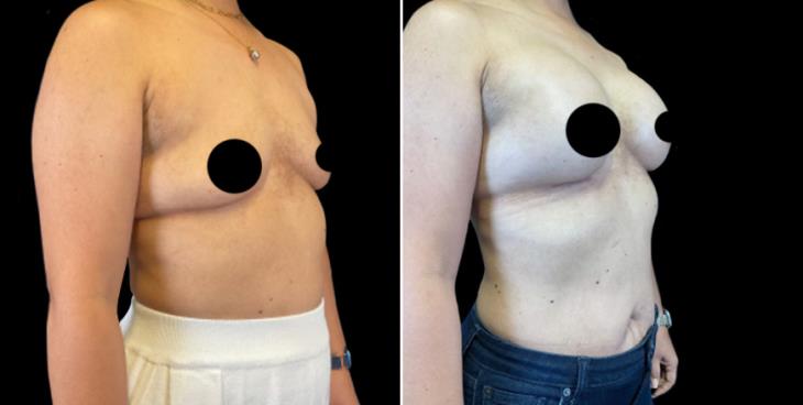 Breast Augmentation With Implants Results Marietta