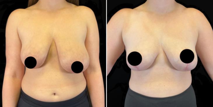 Reduction Mammoplasty