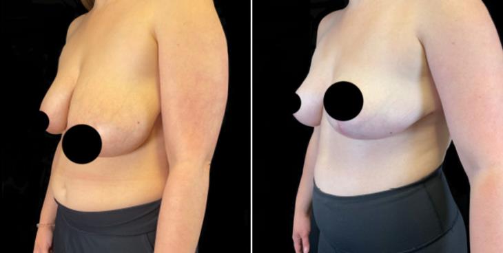 Reduction Mammoplasty Results