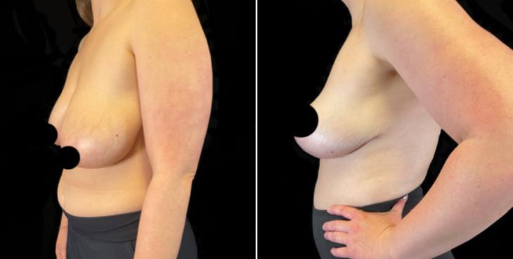 Results Of Reduction Mammoplasty