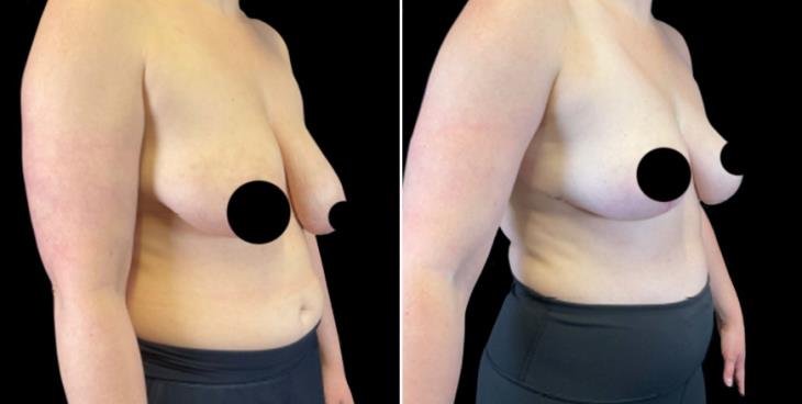 Reduction Mammoplasty In Atlanta