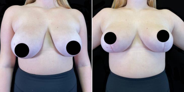 Results Of Reduction Mammoplasty Atlanta