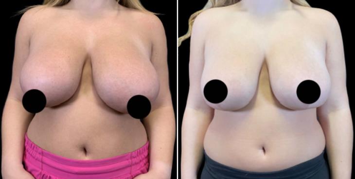 Before And After Reduction Mammoplasty Surgery