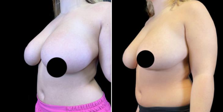 Before & After Reduction Mammoplasty Atlanta