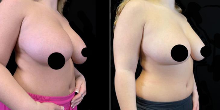 Atlanta Reduction Mammoplasty Before & After