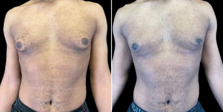 Male Breast Reduction Results Atlanta