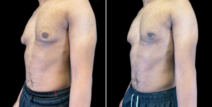 Results Of Male Breast Reduction