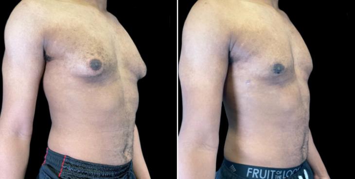 Male Breast Reduction Results Atlanta