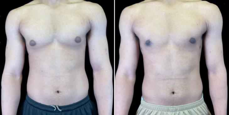 Male Breast Reduction Before & After