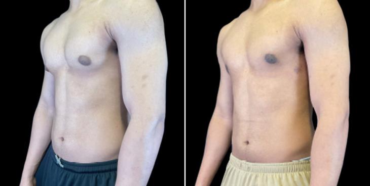 Before & After Male Breast Reduction