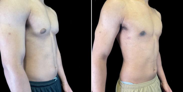 Results Of Male Breast Reduction Atlanta
