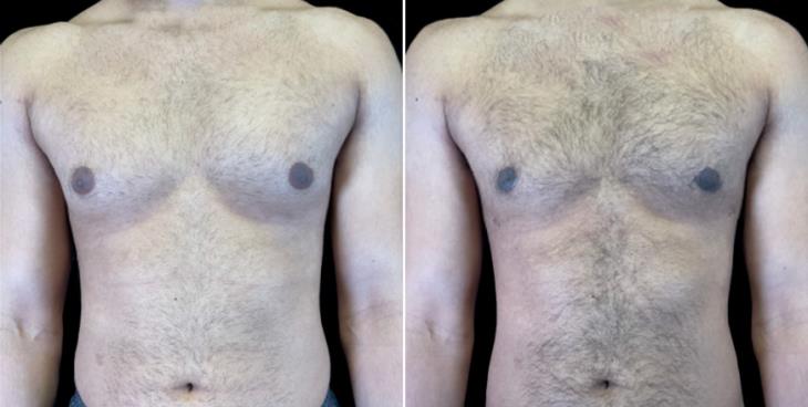 Atlanta Male Breast Reduction Results